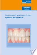 Indirect Restorations book cover